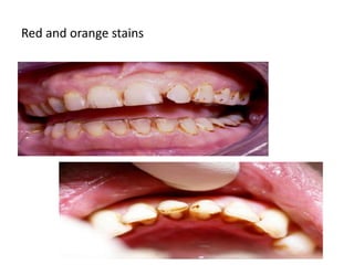 Orange Tooth Discoloration of teeth | PPTX