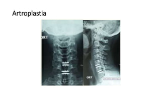 Artroplastia
 