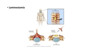 • Laminectomía
 