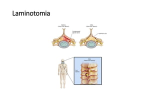 Laminotomia
 