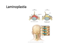 Laminoplastia
 