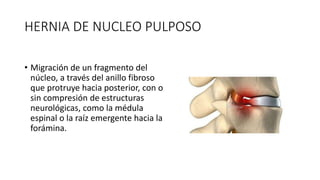 HERNIA DE NUCLEO PULPOSO
• Migración de un fragmento del
núcleo, a través del anillo fibroso
que protruye hacia posterior, con o
sin compresión de estructuras
neurológicas, como la médula
espinal o la raíz emergente hacia la
forámina.
 