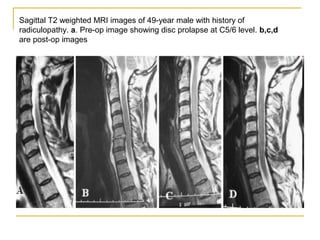 Disc prolapse and degenerative changes | PPT