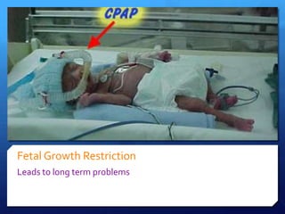 Fetal Growth Restriction
Leads to long term problems
 