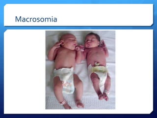 Macrosomia
 