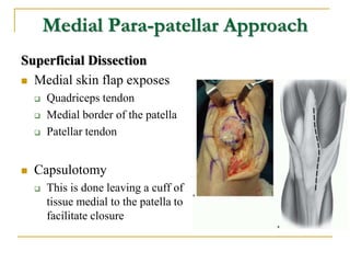 Discuss approaches to the knee and Describe in detail TKR | PPTX