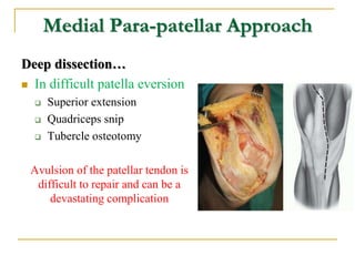 Medial Para-patellar Approach
Deep dissection…
 In difficult patella eversion
 Superior extension
 Quadriceps snip
 Tu...