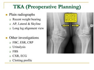 TKA (Preoperative Planning)
 Plain radiographs
 Recent weight bearing
 AP, Lateral & Skyline
 Long leg alignment view
...