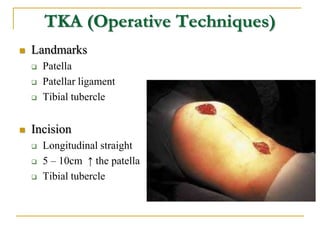 TKA (Operative Techniques)
 Landmarks
 Patella
 Patellar ligament
 Tibial tubercle
 Incision
 Longitudinal straight
...