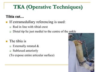 TKA (Operative Techniques)
Tibia cut…
 If extramedullary referencing is used:
 Rod in line with tibial crest
 Distal ti...
