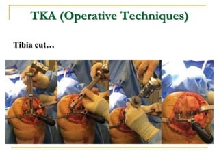 TKA (Operative Techniques)
Tibia cut…
 