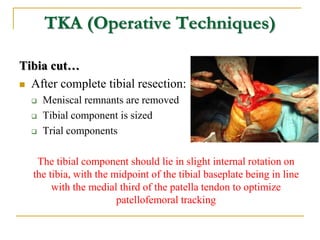 TKA (Operative Techniques)
Tibia cut…
 After complete tibial resection:
 Meniscal remnants are removed
 Tibial componen...