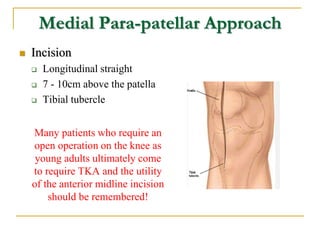 Medial Para-patellar Approach
 Incision
 Longitudinal straight
 7 - 10cm above the patella
 Tibial tubercle
Many patie...