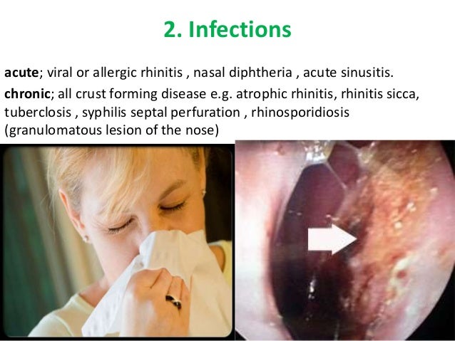Discuss epistaxis kbth