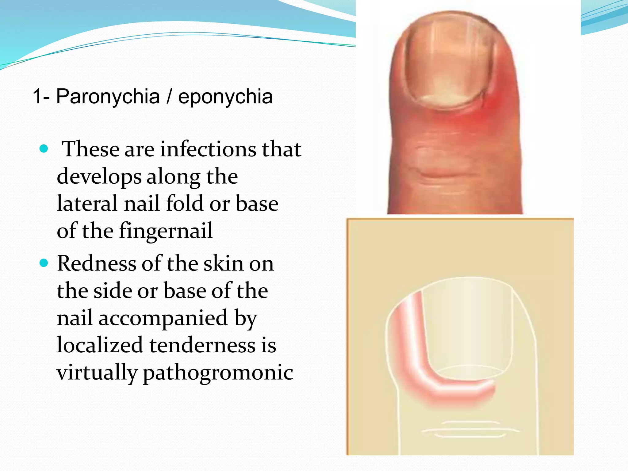 1- Paronychia / eponychia
 These are infections that
develops along the
lateral nail fold or base
of the fingernail
 Redness of the skin on
the side or base of the
nail accompanied by
localized tenderness is
virtually pathogromonic
 