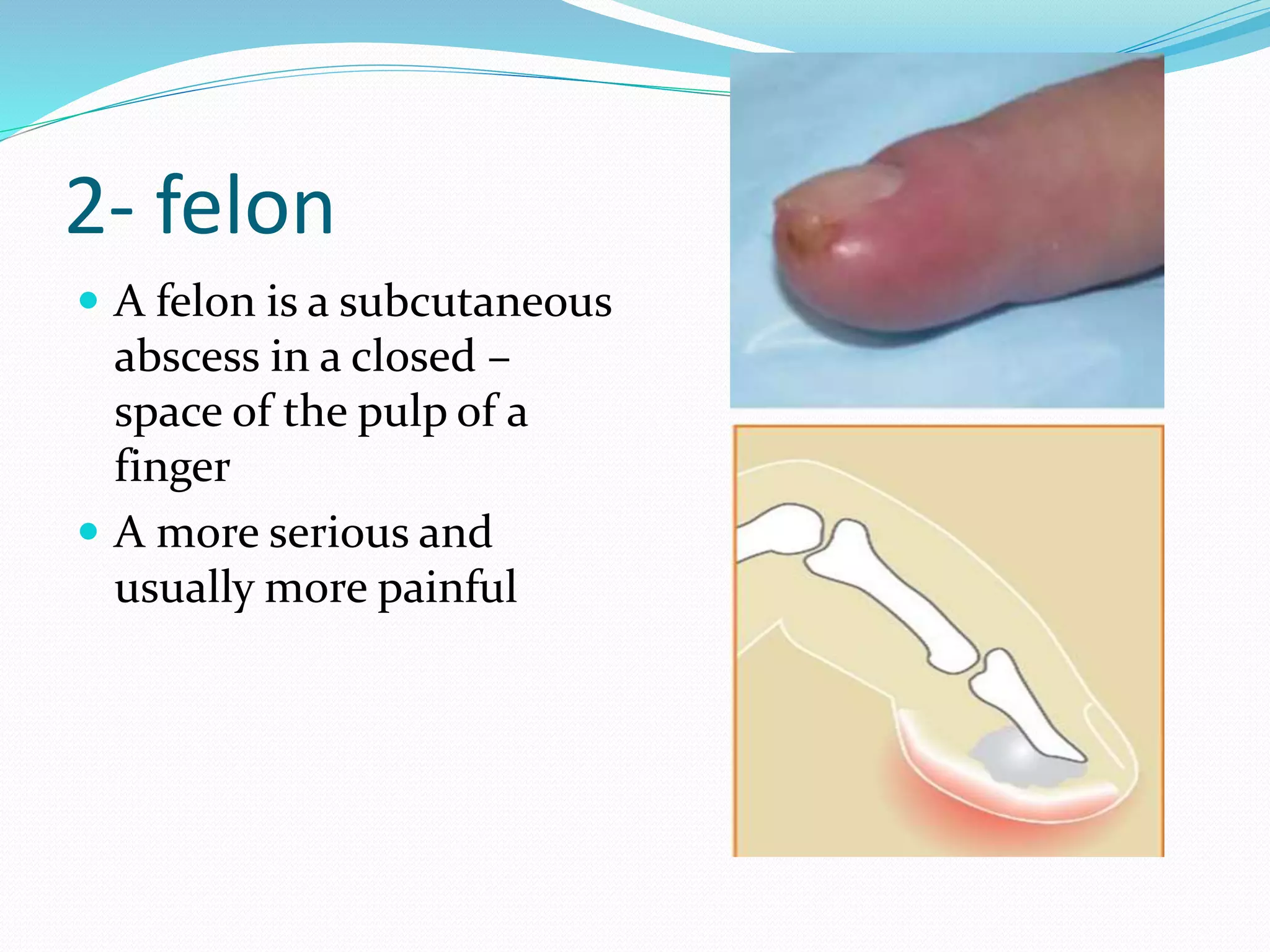 2- felon
 A felon is a subcutaneous
abscess in a closed –
space of the pulp of a
finger
 A more serious and
usually more painful
 