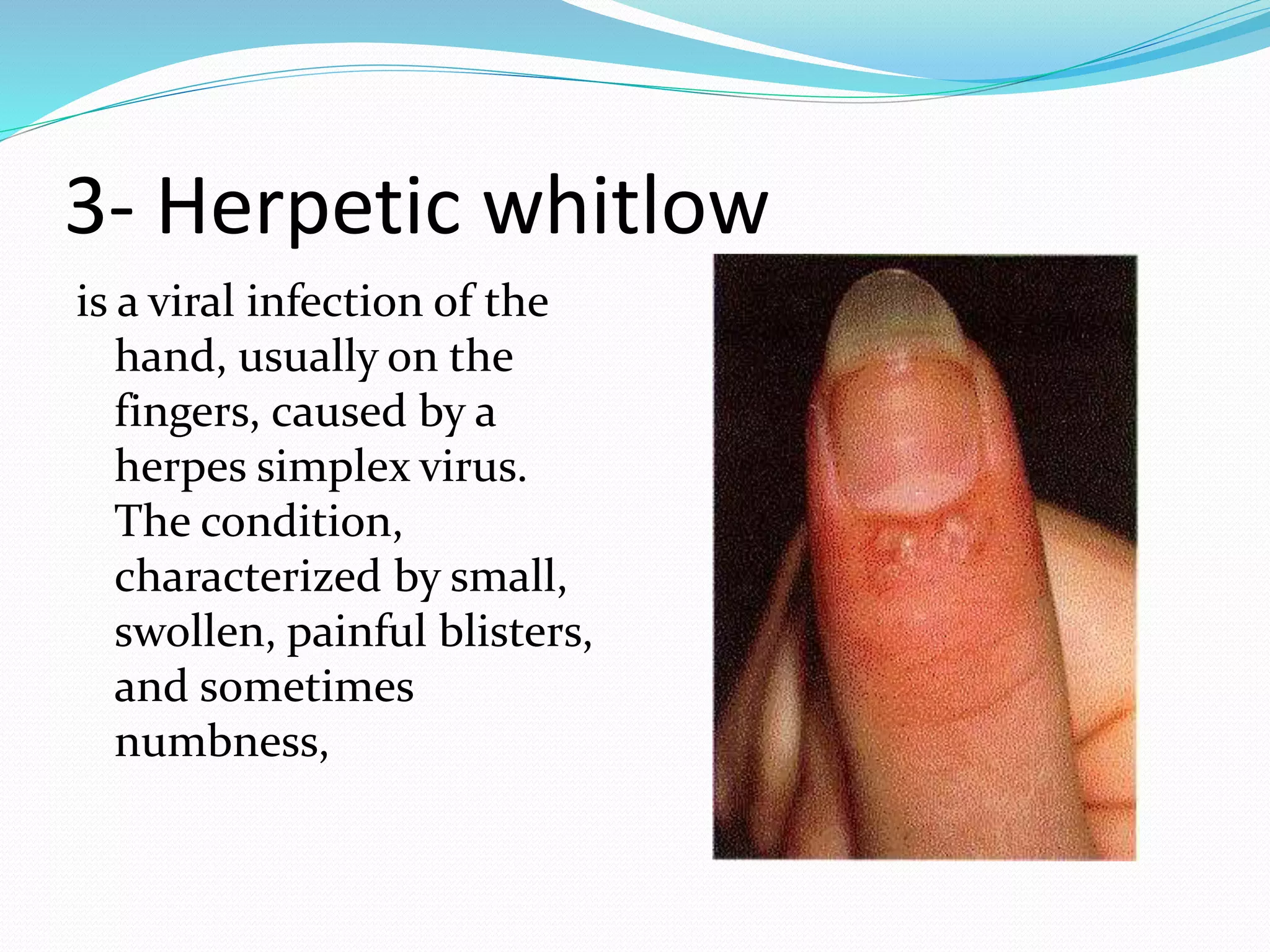 3- Herpetic whitlow
is a viral infection of the
hand, usually on the
fingers, caused by a
herpes simplex virus.
The condition,
characterized by small,
swollen, painful blisters,
and sometimes
numbness,
 