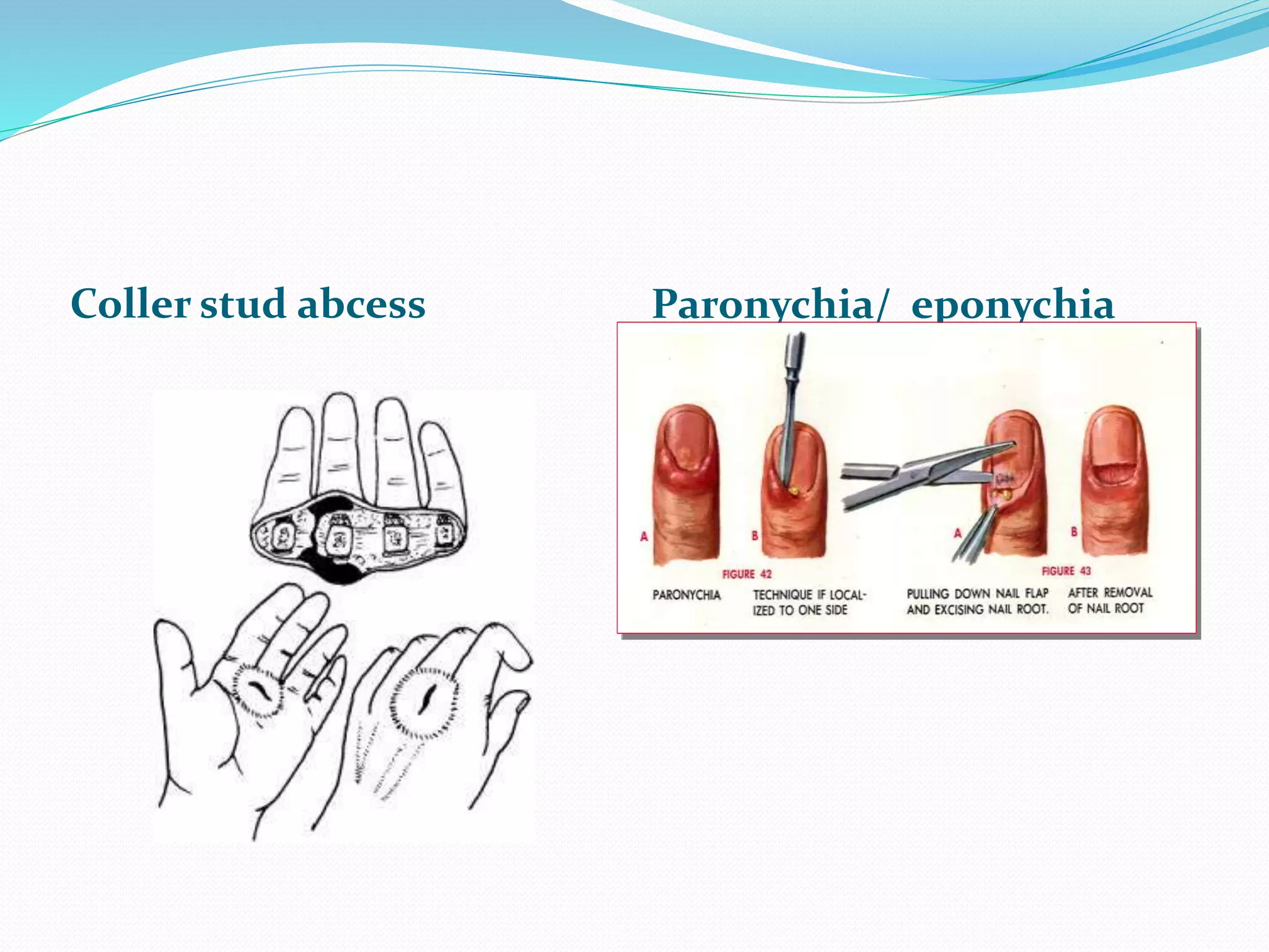 Coller stud abcess Paronychia/ eponychia
 
