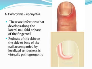 1- Paronychia / eponychia
 These are infections that
develops along the
lateral nail fold or base
of the fingernail
 Redness of the skin on
the side or base of the
nail accompanied by
localized tenderness is
virtually pathogromonic
 