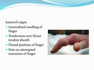 kanavel’s signs
 Generalised swelling of
finger
 Tenderness over flexor
tendon sheath
 Flexed position of finger
 Pain on attempted
extension of finger
 