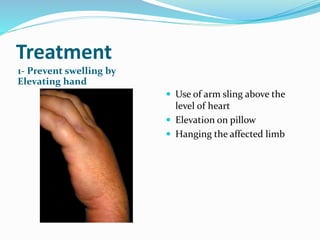 Treatment
1- Prevent swelling by
Elevating hand
 Use of arm sling above the
level of heart
 Elevation on pillow
 Hanging the affected limb
 