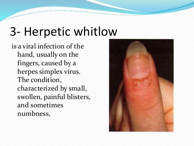 Discuss Hand Infection 2