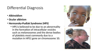 Comprehensive Overview of Oculocutaneous Albinism: Genetics, Clinical ...