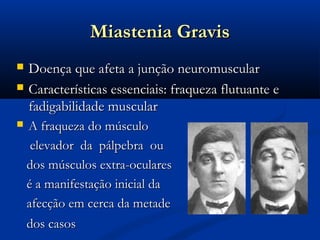 Miastenia Gravis
   Doença que afeta a junção neuromuscular
   Características essenciais: fraqueza flutuante e
    fadigabilidade muscular
   A fraqueza do músculo
     elevador da pálpebra ou
    dos músculos extra-oculares
    é a manifestação inicial da
    afecção em cerca da metade
    dos casos
 