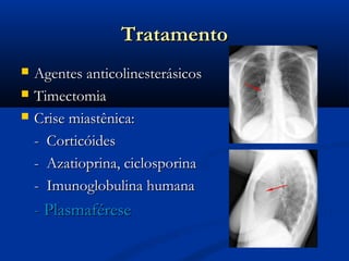 Tratamento
   Agentes anticolinesterásicos
   Timectomia
   Crise miastênica:
    - Corticóides
    - Azatioprina, ciclosporina
    - Imunoglobulina humana
    - Plasmaférese
 