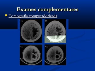 Exames complementares
   Tomografia computadorizada
          SC           SC




          CC           CC
 