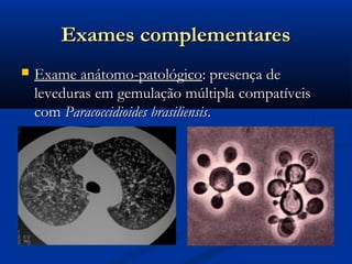 Exames complementares
   Exame anátomo-patológico: presença de
    leveduras em gemulação múltipla compatíveis
    com Paracoccidioides brasiliensis.
 