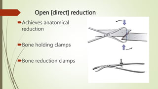 DISCUSS PRIN & ADVANCES OF INT FIXATION OF FRACTURES.pptx