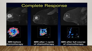 Inflammatory Breast Cancer Algorithm Discuss the management of inflammatory Breast Cancer.pptx