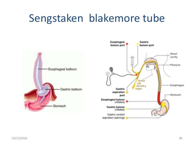 sengstaken blakemore tube