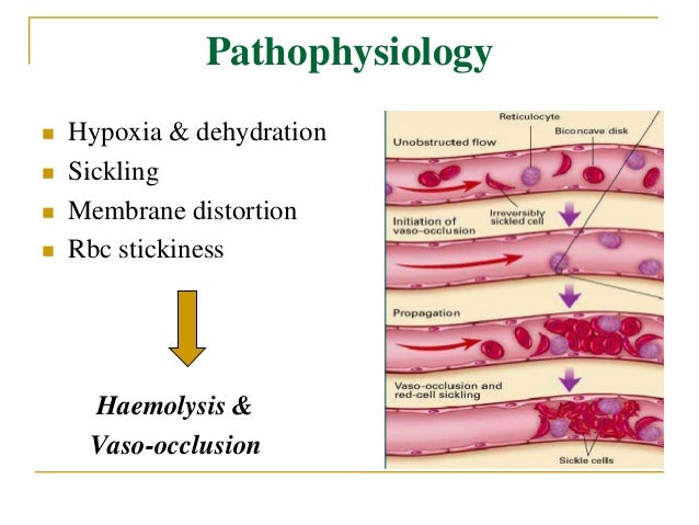 Discuss the orthopaedic manifestations of sickle cell disease