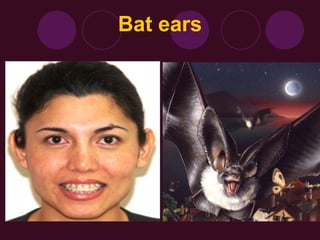Bat Ear Rotation diseaes of external ear undergraduate ppt | PPT
