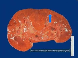 Abscess formation within renal parenchyma

 