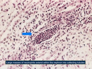 Large masses of neutrophils extend within the nephron into collecting tubules

 