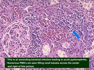This is an ascending bacterial infection leading to acute pyelonephritis.
Numerous PMN's are seen filling renal tubules across the center

and right of this picture

 