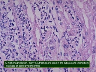 At high magnification, many neutrophils are seen in the tubules and interstitium
in a case of acute pyelonephritis

 