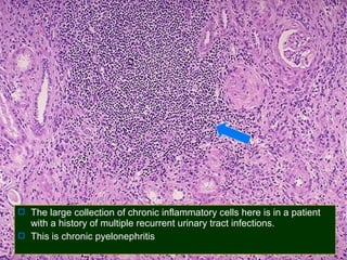  The large collection of chronic inflammatory cells here is in a patient

with a history of multiple recurrent urinary tract infections.
 This is chronic pyelonephritis

 