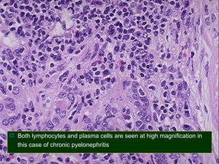  Both lymphocytes and plasma cells are seen at high magnification in

this case of chronic pyelonephritis

 