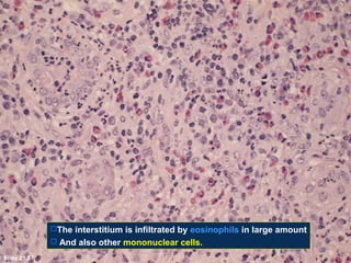 The interstitium is infiltrated by eosinophils in large amount
 And also other mononuclear cells.
Slide 21.57

 