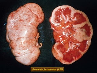 )Acute tubular necrosis (ATN

 