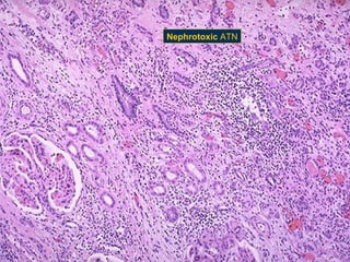 Nephrotoxic ATN

 