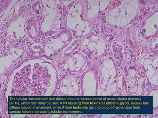 The tubular vacuolization and dilation here is representative of acute tubular necrosis
(ATN(, which has many causes. ATN resulting from toxins as ethylene glycol, usually has
diffuse tubular involvement, while if from ischemia (as in profound hypotension from
cardiac failure( has patchy tubular involvement.

 