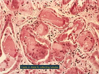 Casts in distal & collecting tubules

 