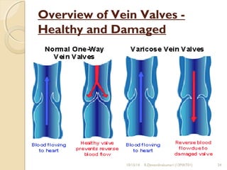 Overview of Vein Valves - 
Healthy and Damaged 
10/15/14 R.Devendirakumari (13MAT01) 24 
 