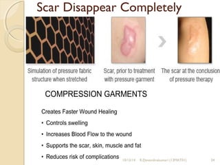 Scar Disappear Completely 
10/15/14 R.Devendirakumari (13MAT01) 34 
 