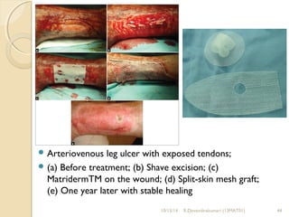 Arteriovenous leg ulcer with exposed tendons; 
(a) Before treatment; (b) Shave excision; (c) 
MatridermTM on the wound; (d) Split-skin mesh graft; 
(e) One year later with stable healing 
10/15/14 R.Devendirakumari (13MAT01) 44 
 